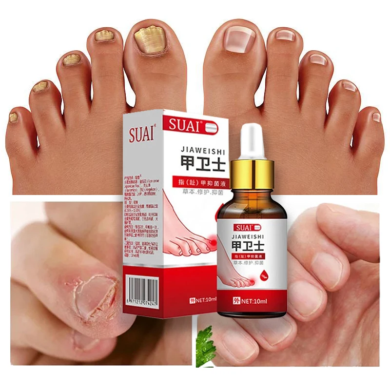 

Сыворотка для лечения Ногтей от грибков, онихомикоз, паронихия, анти-инфекция, ног, грибка, удаление рук и ног, восстанавливающий гель, уход, ...