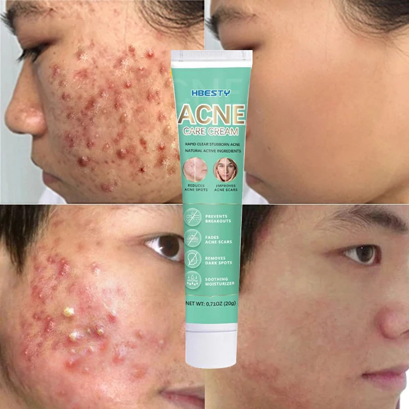 

Acne Treatment Face Cream Herbal Pimples Acne Marks Spots Scar Removal Anti-acne Gel Oil Control Shrink Pores Smooth Skin Care