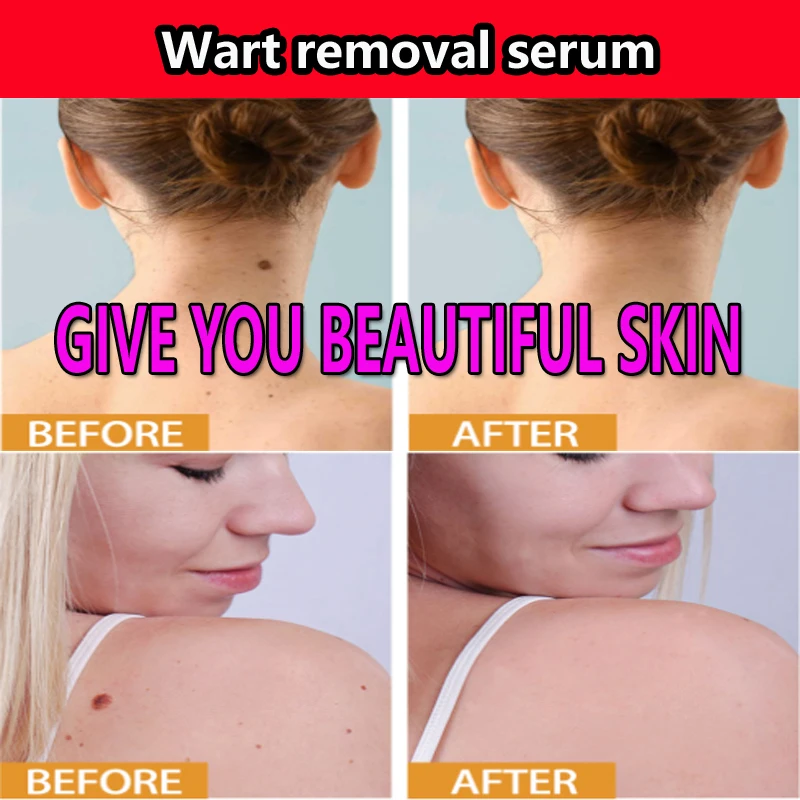 Skin Hand And Foot Removal Corns Plantar Warts Essential Oil