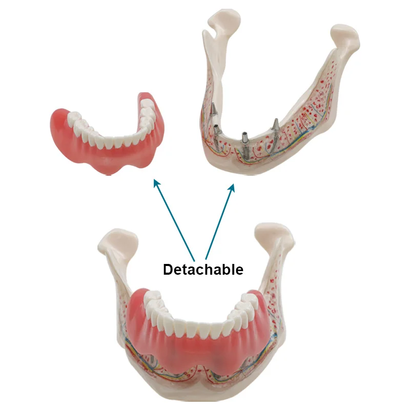 

Модель зубного импланта, демонстрационная модель зубов, стоматологический инструмент, стоматологические материалы