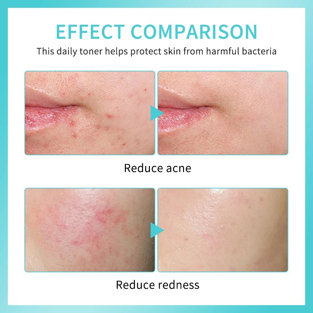 30 мл спрей для оказания первой помощи лица с гипохлористой кислотой красного и