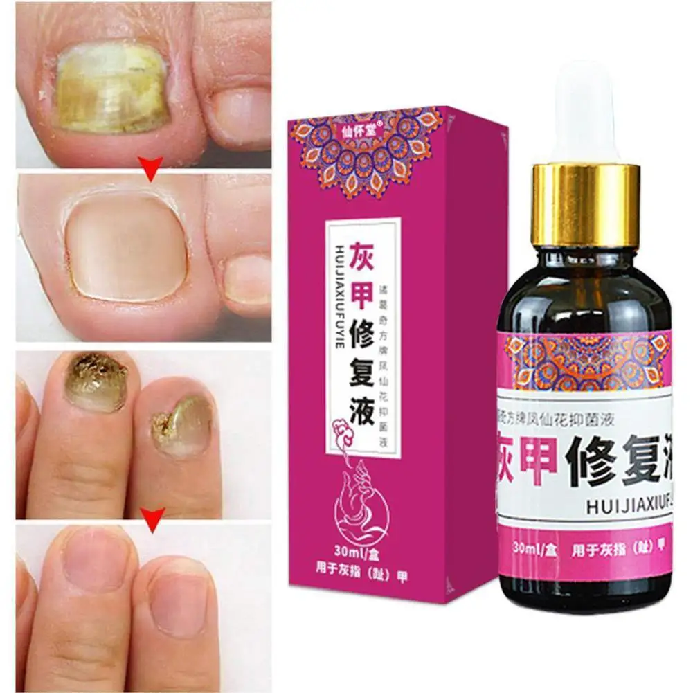 

Fungal Nail Treatment Serum Foot Nail Repair Essence Care Whitening Toe Nail Fungus Removal Gel Anti Infection Onychomycosis