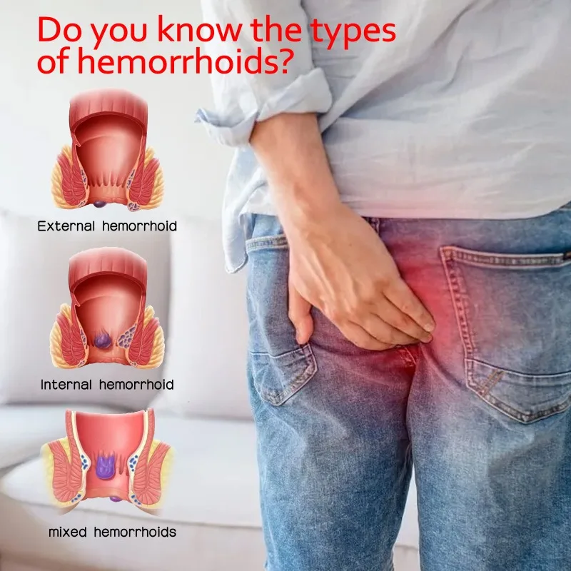 Крем от геморроя нежное облегчение внутренний внешний геморрой удаление
