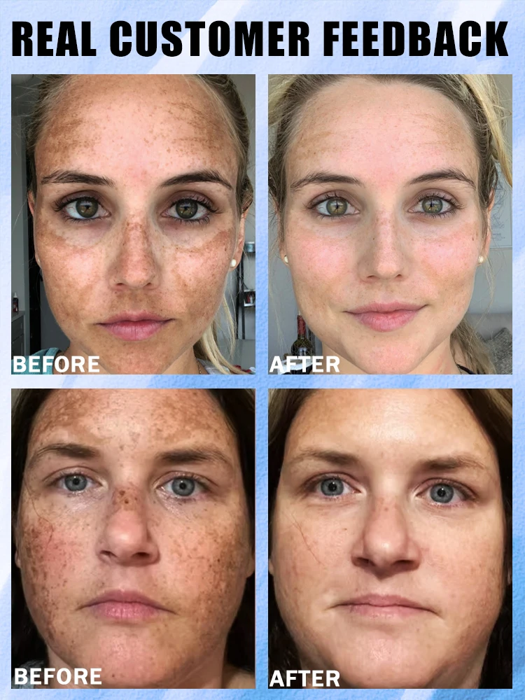 afe и быстрое удаление темных пятен