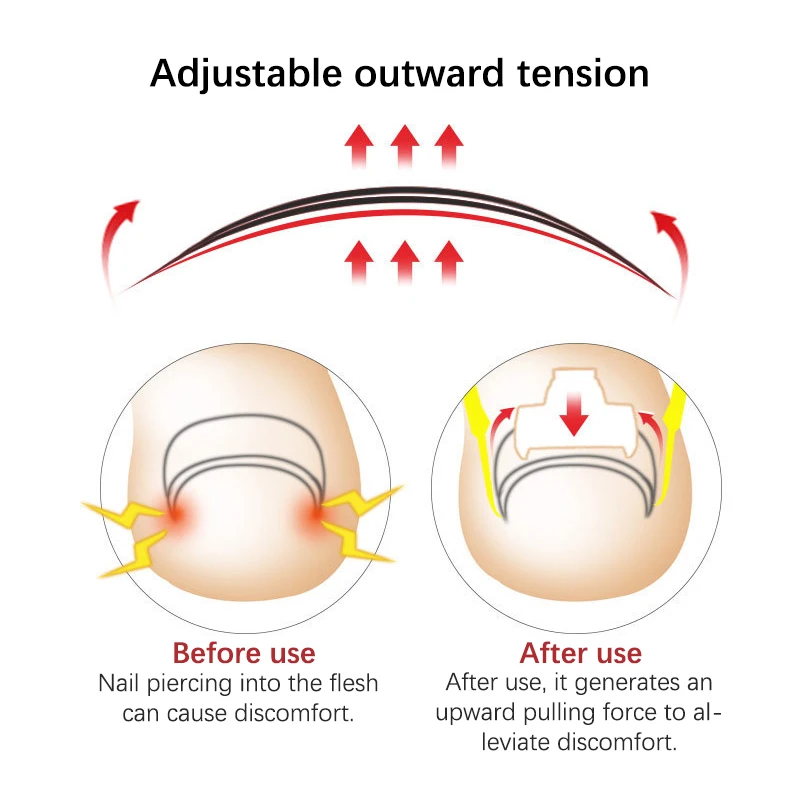 Набор медицинских корректирующих фиксаторов для вросших ногтей