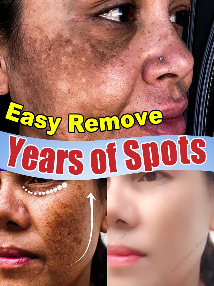 skutecznie usuwa ciemne plamy