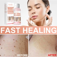 wart removal body quyou ointment youlong skin care ke wart flat spot nevus care cream degreasing granule moles removal