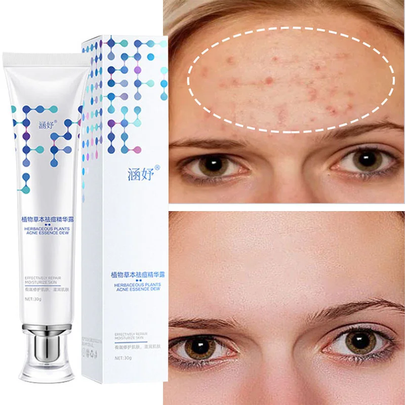 

Herbal Acne Removal Face Gel Pimple Treatment Cream Fade Acne Scar Marks Shrink Pore Oil Control Moisturizing Repair Facial Care