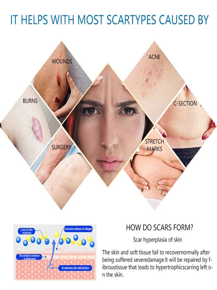 Келоидный крем