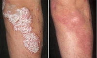 fast effective psoriasis cream dermatitis eczematoid eczema ointment treatment psoriasis eliminate winter dry itching