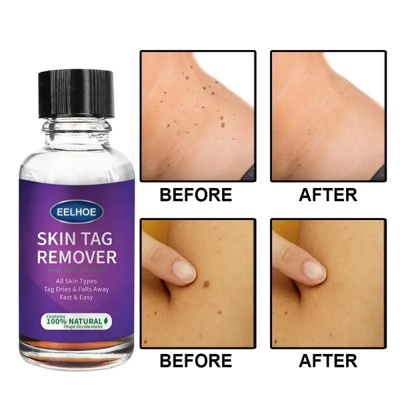 

10/30ml Mole & Skin Tag Removal Solution Painless Mole Skin Dark Spot Removal Face Wart Tag Removal Removal Cream