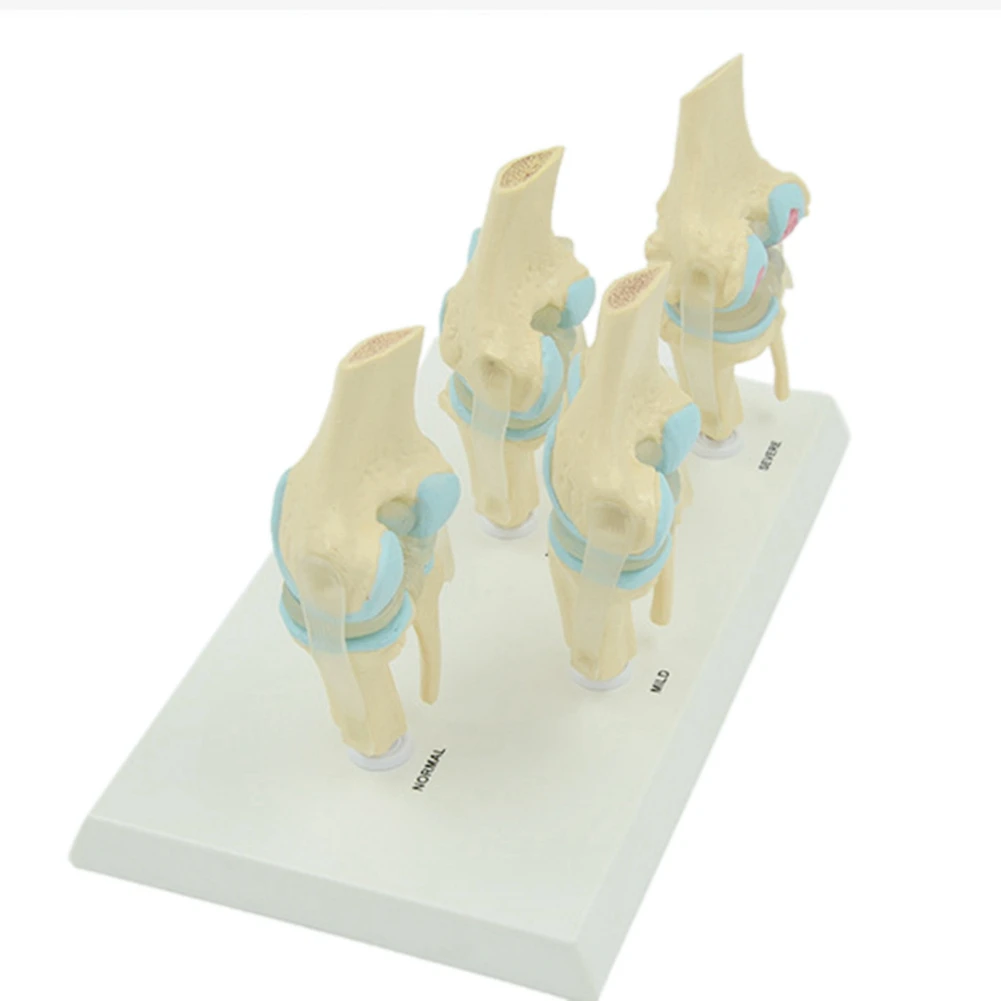 Анатомические человеческие дегенеративные наколенные суставы рандомные