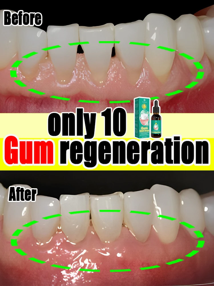 Регенерация атрофии регенерации десен отеки и удаление боли черные треугольники