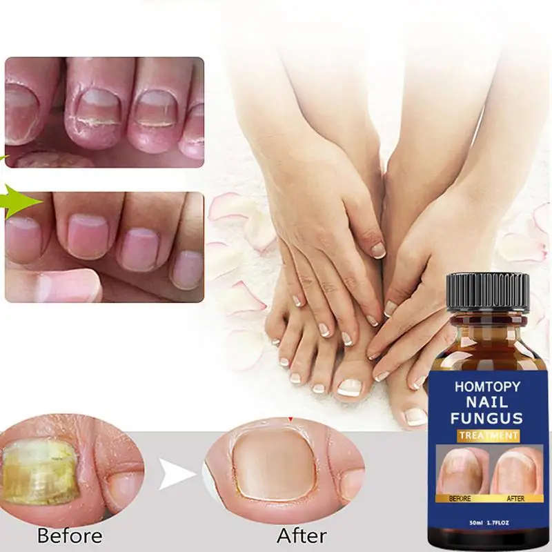 

Sdotter Nail Strengthener Fungi Remover Solution Fast Strong Nails Growing Serum Shine Restoring Brittle Nails Corrector Nail Ca