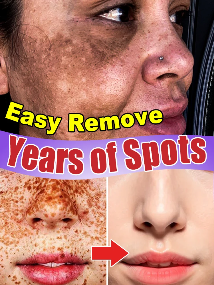 afe и быстрое удаление темных пятен