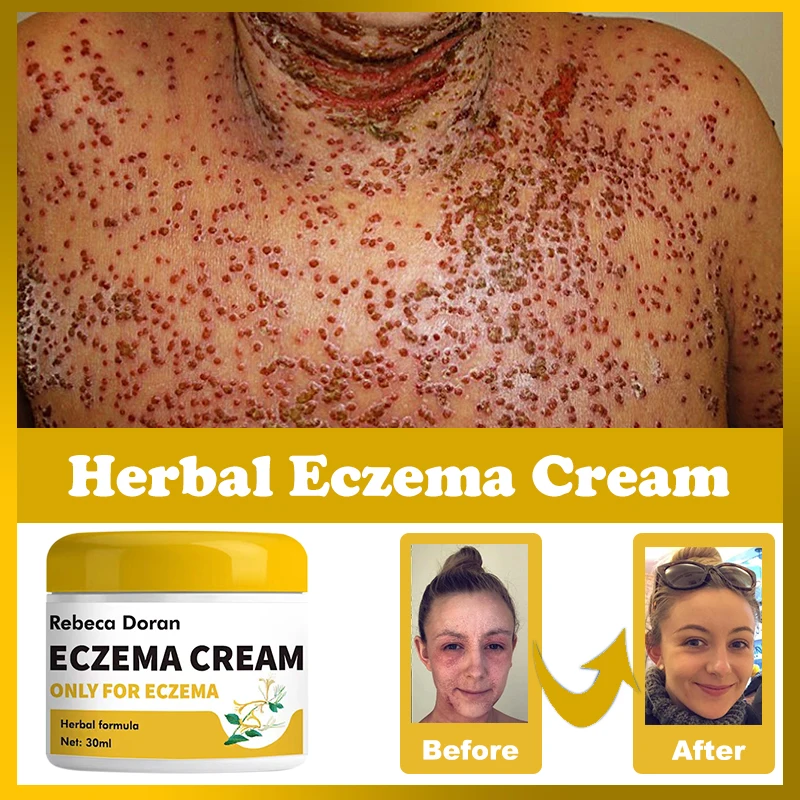 

Eczema Ointment Eczema Eczema Treatment Hand Tinea Foot Odor Versicolor Inhibit Dermatitis Fungus Anti-itch Cream