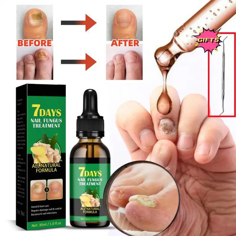 

1/2 шт., жидкость для удаления грибка на ногтях, 30 мл