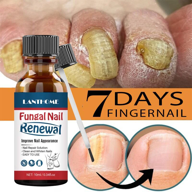 

Nails Fungal Treatment Serum Paronychia Treat Nail Cuticle Remover Fungu Remedy Anti-infection Care Oil Nourish Repair Nail 10ML