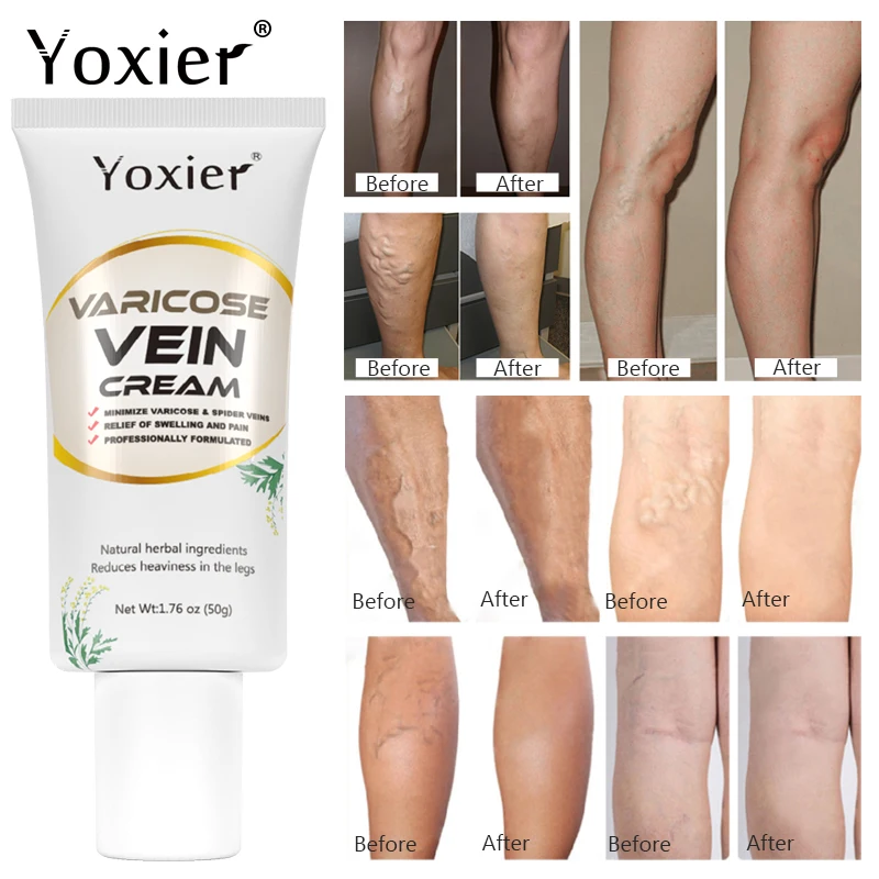 

Крем для облегчения варикозного расширения вен, васкулит, флебит, паук, обезболивающая мазь, травяной пластырь для кровообращения, уход за т...