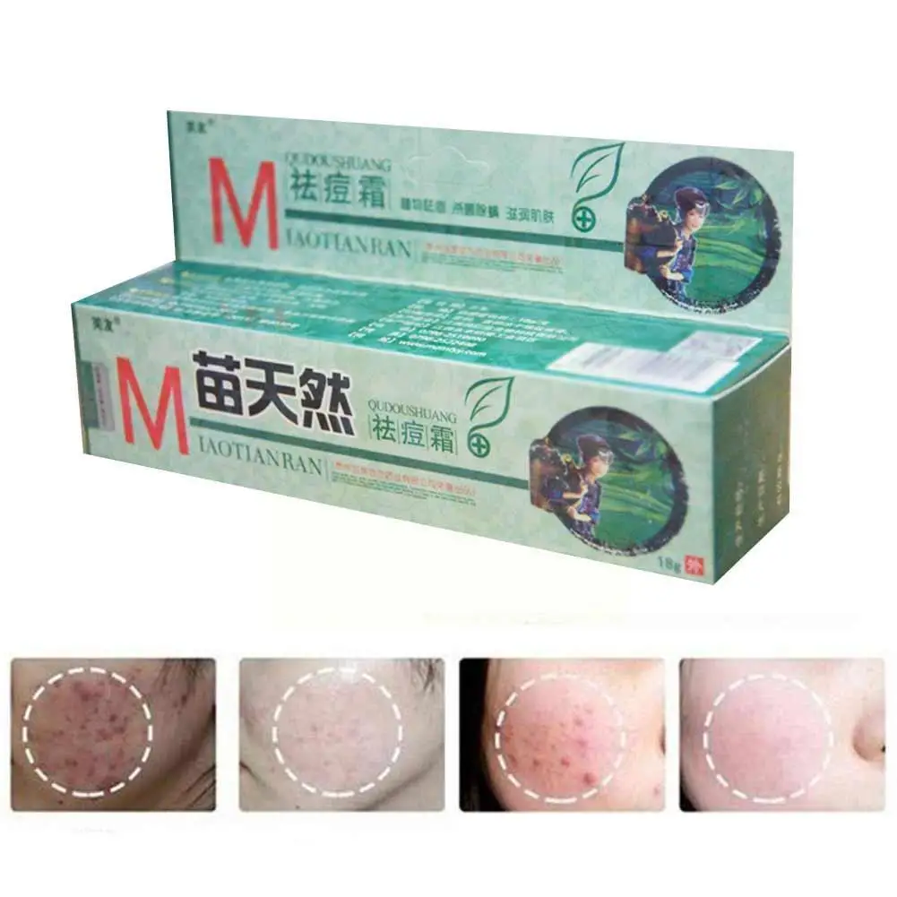 

Оригинальный крем для удаления акне Fuyou Miaotianran, бактерицидный увлажняющий и удаляющий клещи массажный крем для кожи, крем для лечения, 1 шт. K8R9