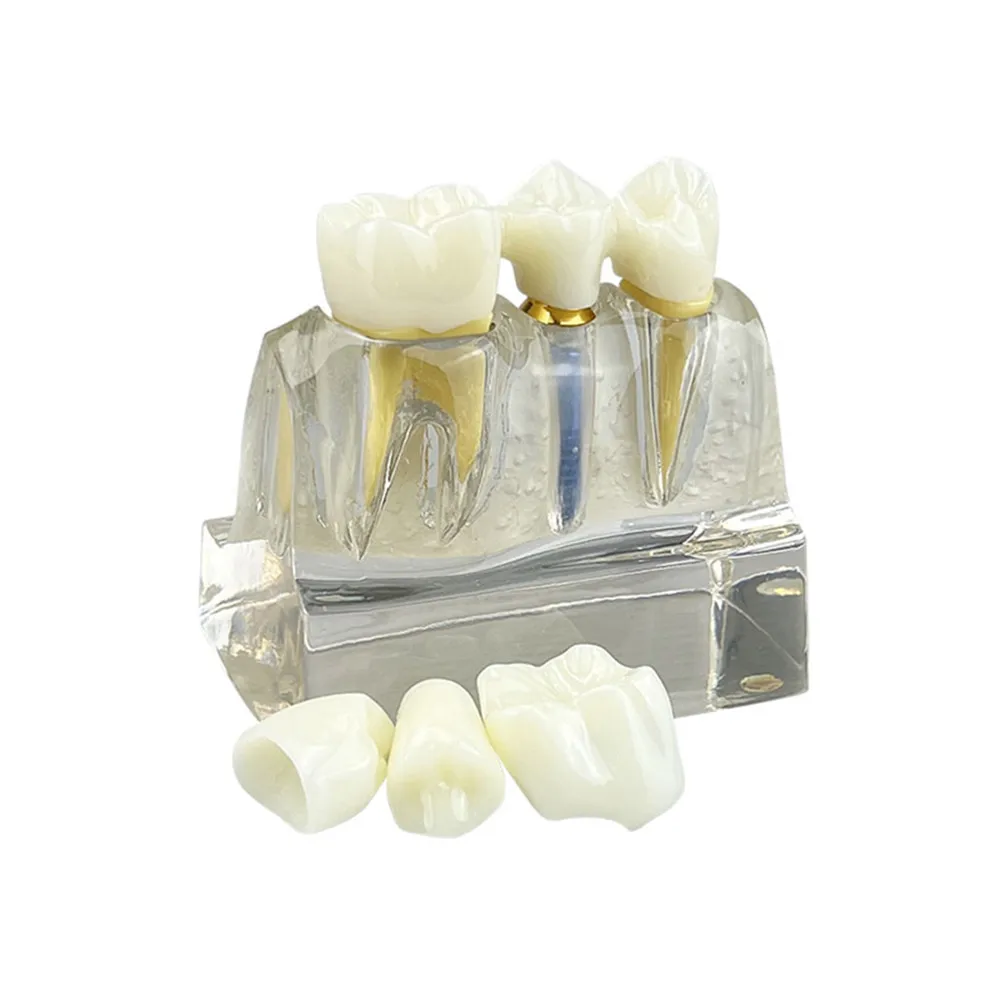 Тренировочная модель для зубного импланта 4-кратный анализ имплантов коронного