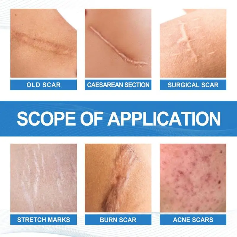 Рисунок 4 - Избавление от шрамов от растяжек