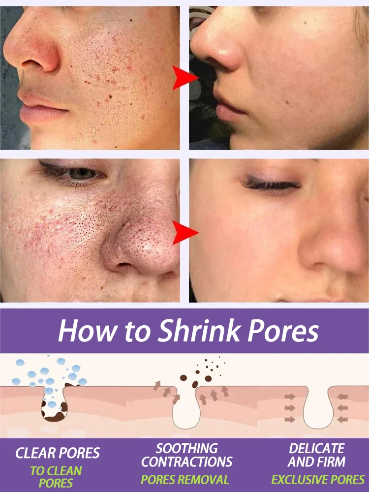 Сыворотка для сужения пор с салициловой кислотой быстрое удаление пятен гладкой