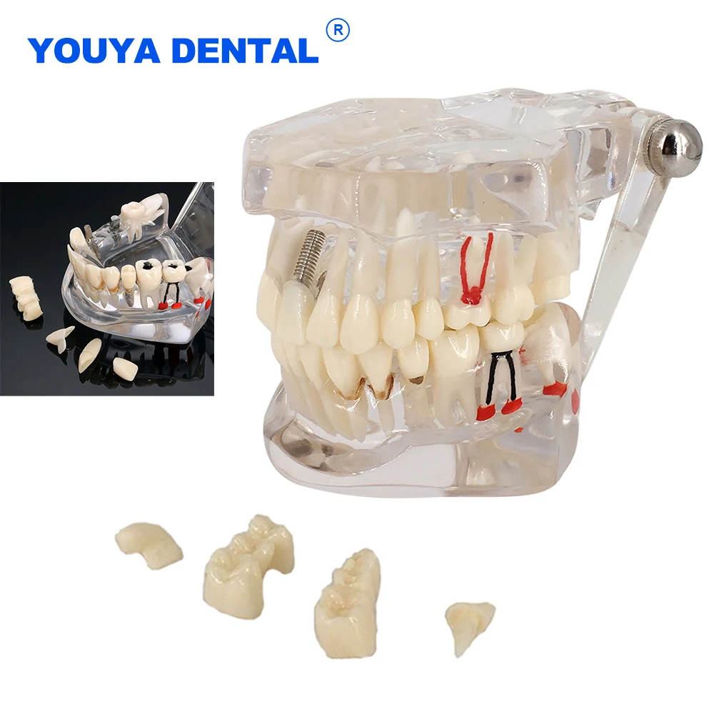 Implant Dental Model Disease Teeth Neural Repair Pathological Typodont Restoration Bridge Teaching Study Medical Science Disease