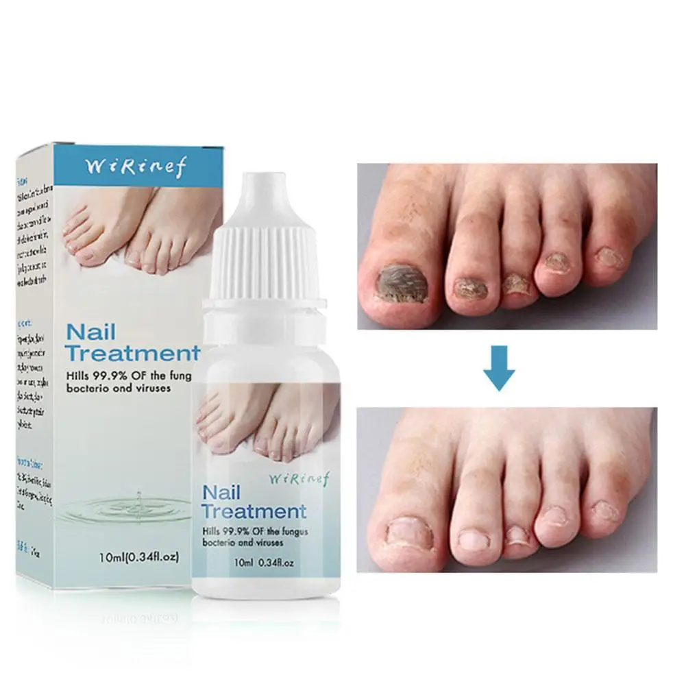 

Nail Fungus Treatment Serum Foot Repair Essence Toe Nail Fungus Removal Gel Anti Infection Paronychia Onychomycosis Cream 10ML