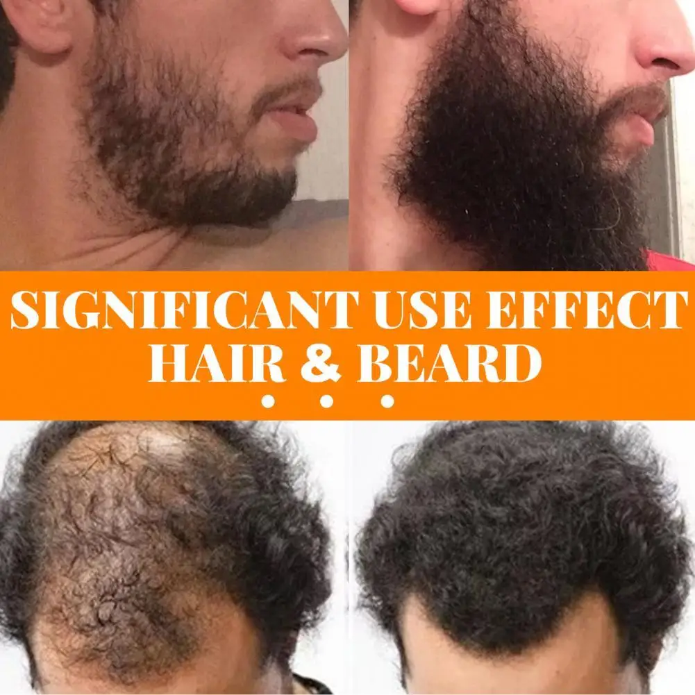 

30ml Practical Hair Growth Essence Spray Beard Essence Safe Ingredient Long Lasting