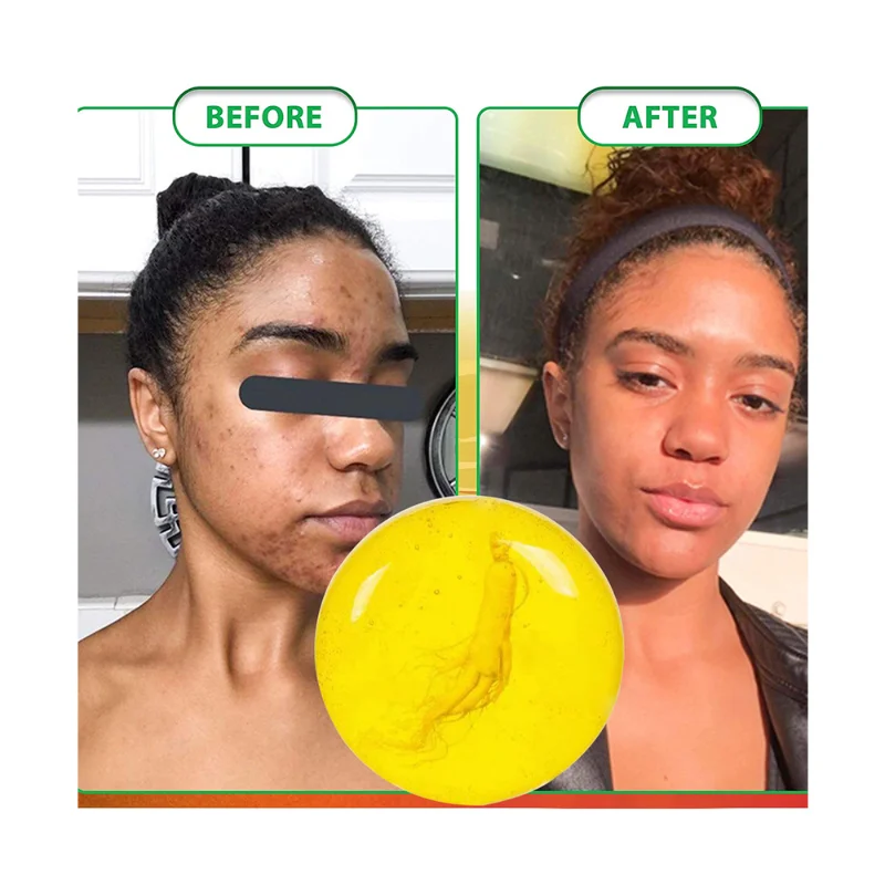 Добавьте акне прыщи пятна шрамы корректор темных пятен афроамериканское мыло