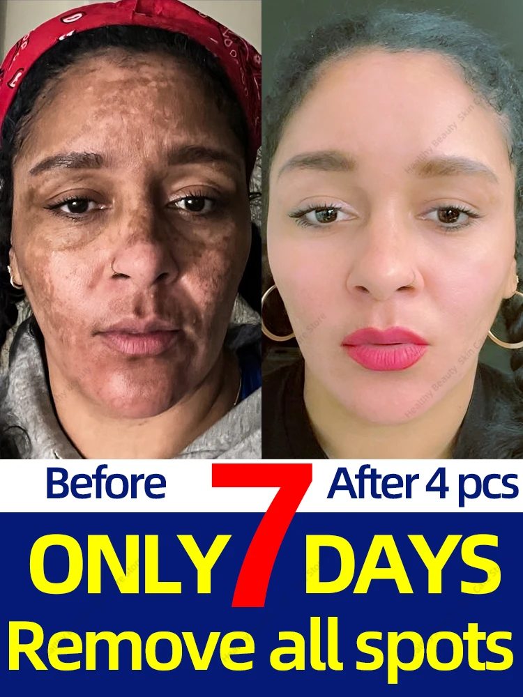 Восстанавливает веснушки мелазма