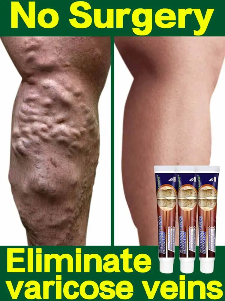 

Effective Varicose Vein Relief Cream Eliminate Vasculitis Phlebitis Spider Legs Treatment Soothing Relieve Pain Herbal Ointment