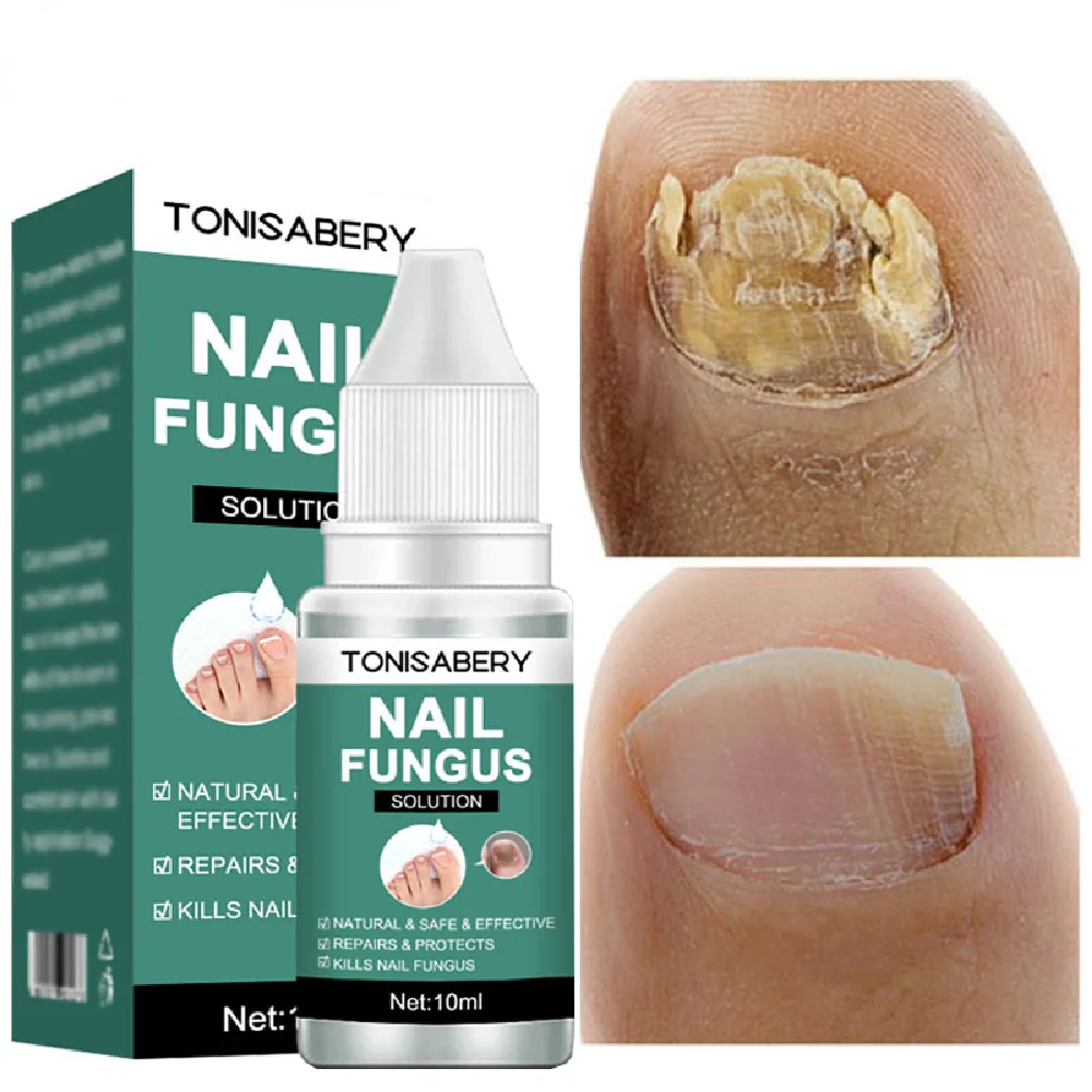 

Nail Fungal Treatment Feet Care Essence Anti Infection Paronychia Onychomycosis Nail Foot Toe Nail Fungus Removal Gel Products