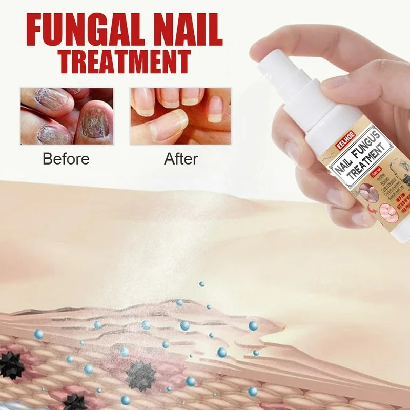 Фото 30ml Nail Fungal Treatment Spray Feet Repair Serum Nails Foot Toe Fungus Removal Gel Anti Infection Paronychia Onychomycosis №2