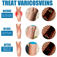 30ml veinhealing varicose veins treatment spray smoothen the bulge of blood vessels earthworm legs without surgery leg care tool