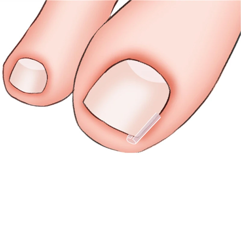 

10Pcs Silicone Ingrown Nail Pad Nail Filling Nail Groove Pad Ingrown Nail Corrector Relief Pain Paronychia Correction Tools