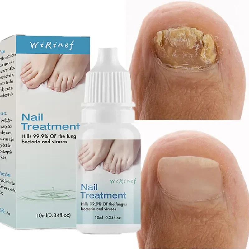 

Nail Fungus Treatment Serum Hand Foot Toe Nails Fungal Removal Gel Anti Infection Paronychia Onychomycosis Repair Care Products