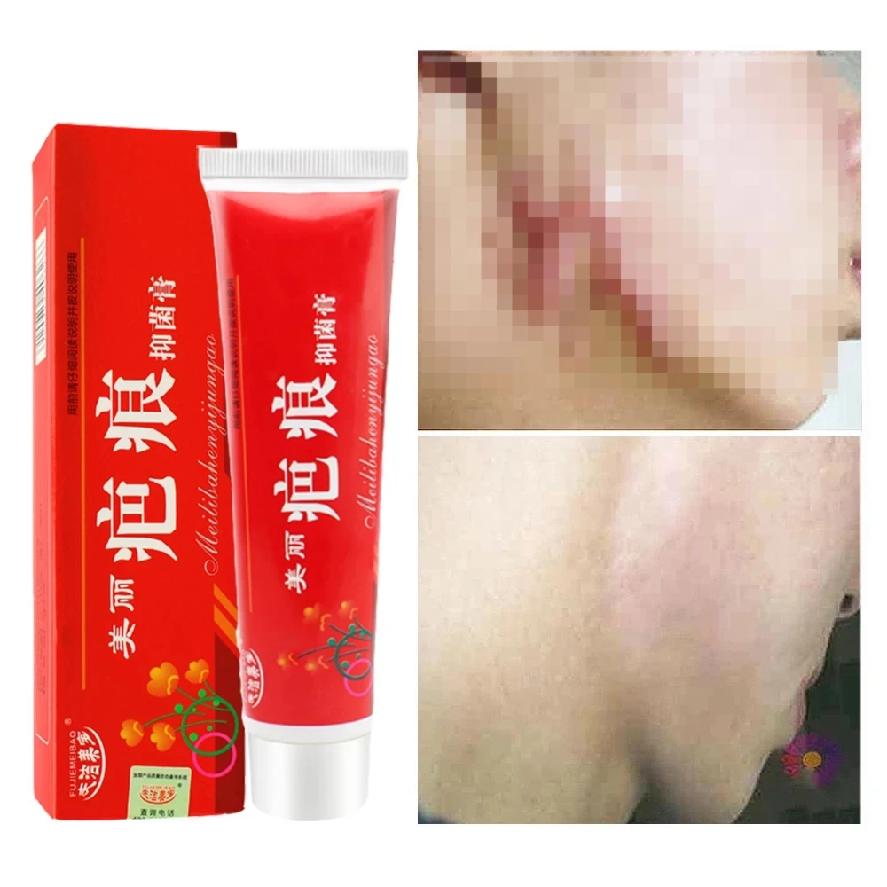 

3Pcs 60ML Acne Scar Removal Cream Pimples Stretch Marks Face Gel Remove Acne Smoothing Whitening Moisturizing Body Skin Care