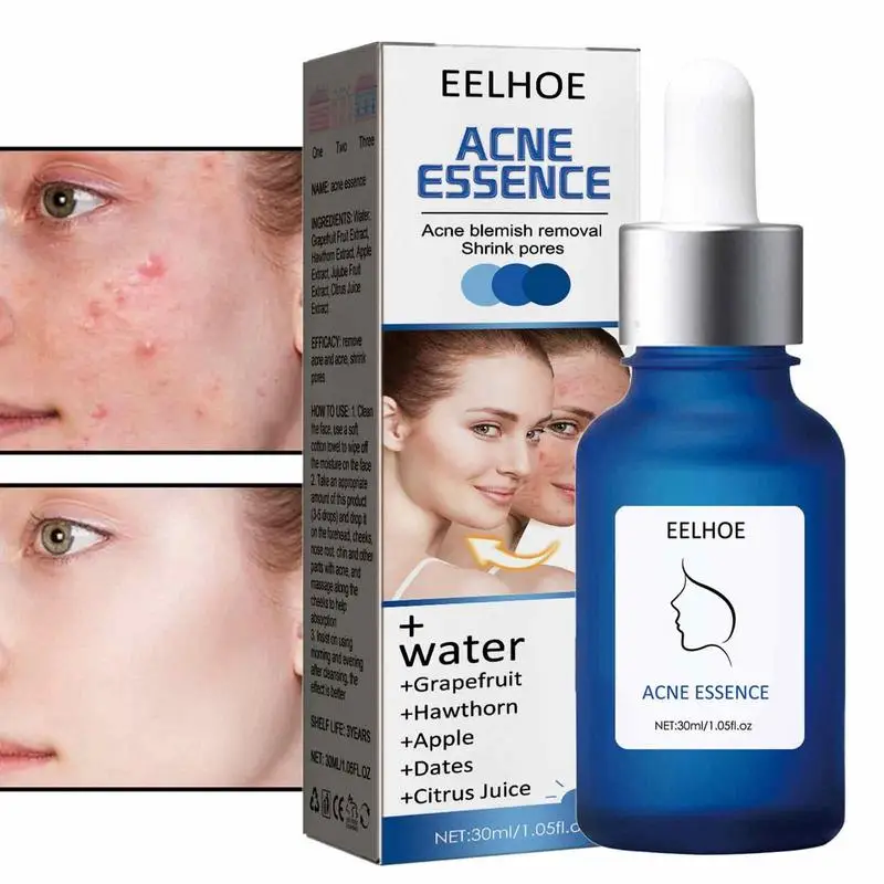 

Жидкость для восстановления кожи от прыщей, эссенция для восстановления пор 30 мл, минимизатор пор, сыворотки для лица, мгновенно увлажняет, ...