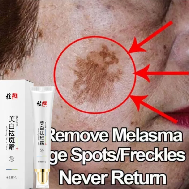 

Effective Whiten Freckle Cream Remove Dark Spot Melasma Fade Melanin Anti-Pigmentation Improve Dullness Brighten Face Skin Care