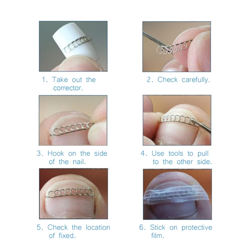 

Stainless Steel Nail Straightener Clip Ingrown Toenails Correction Foot Care Tool Ingrown Toenail Corrector Wire Drop Shipping