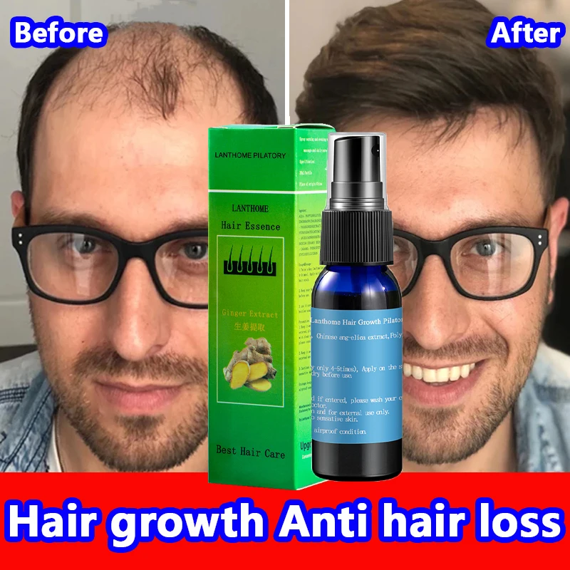 

Мощный имбирный продукт для роста волос, быстрорастущее устройство для роста волос, косметический уход за волосами, предотвращение выпадения волос, лечение кожи головы для мужчин, женщин и мужчин