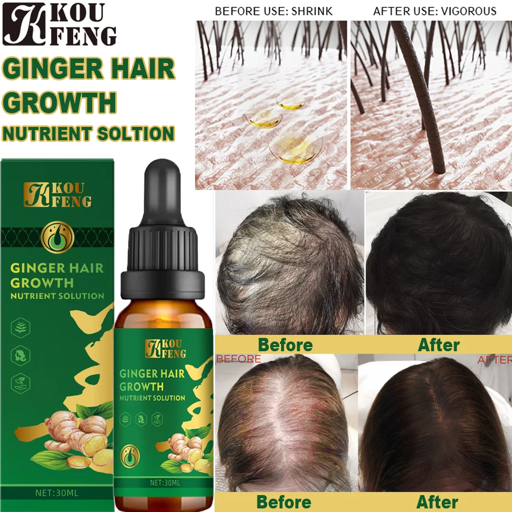

Koufeng Ginger Hair-Fixing Nutrient Solution Hair Growth Nutrient Solution For Men Women Fast Regrowth Hair Treatment Hair Grow