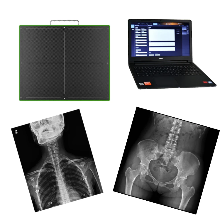 

17*17" digital wireless x-ray flat panel detector for DR