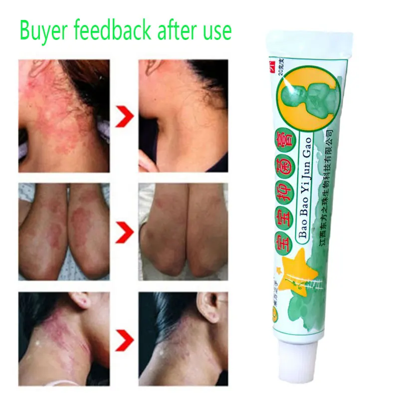Itching For Kids Baby Body Cream Baby Psoriasis Cream Neurodermatitis Ointment  Eczema Ointments Eczema Allergic15g