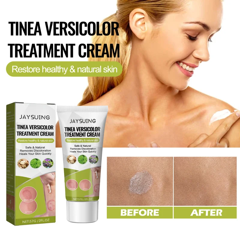 

Sweat spots lighten vitiligo Ointment Remove Ringworm Eliminate White Spot Removal Leukoplakia Treatment skin repair care cream