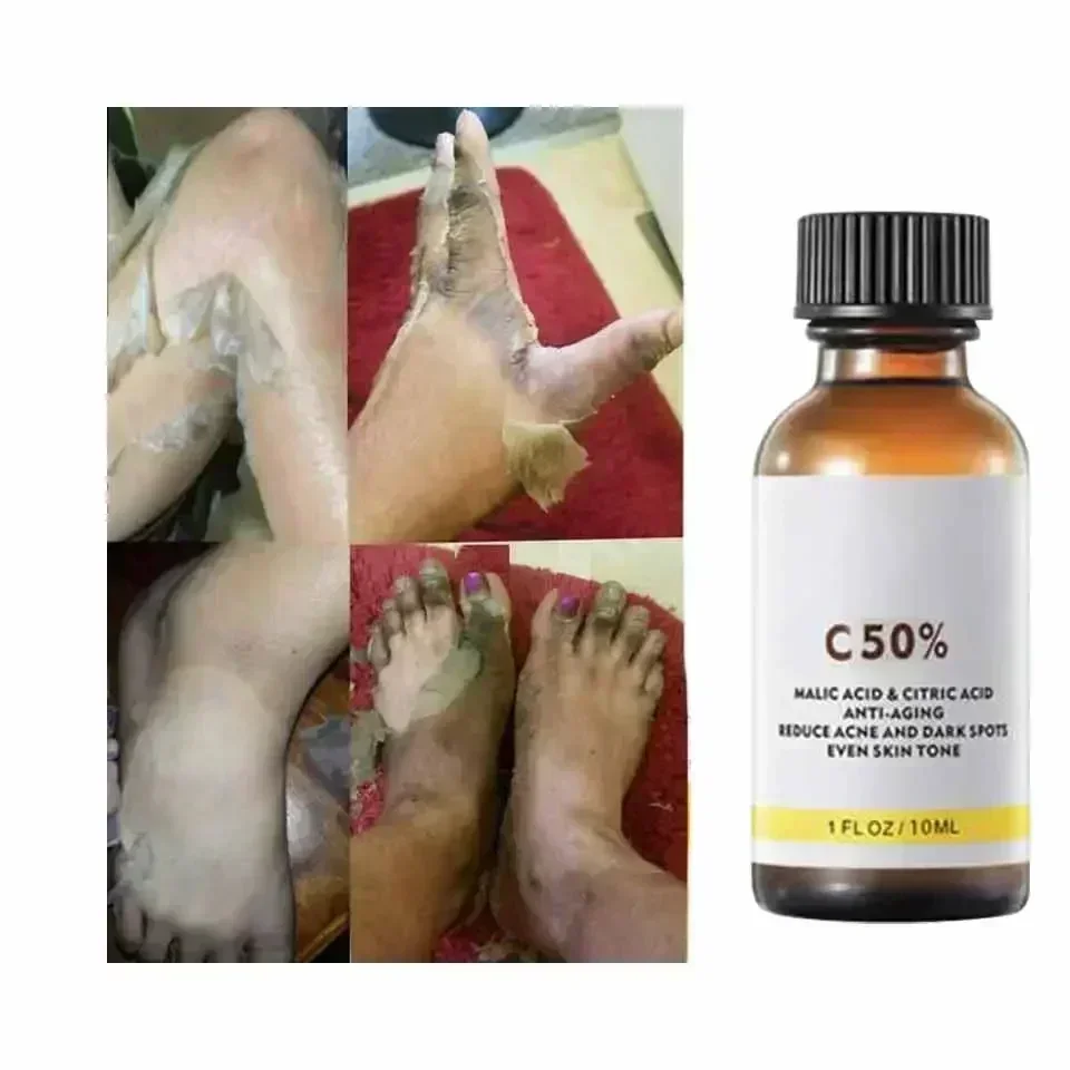 ГОРЯЧАЯ ПРОДАЖА высококачественный химический пилинг кислоты суперсилие