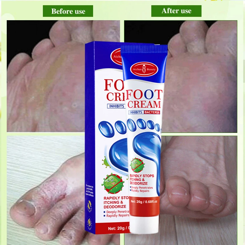 

Антизуд от пота, ингибитор грибка берибери, крем для ног, лечение против зуда, удаление пилинга, Tinea Pedis, восстанавливающая мазь