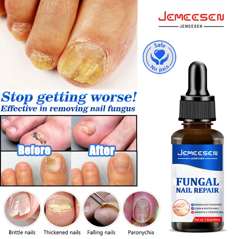 

Jemeesen Nail Fungus Treatment 7 DAYS Painless Fungal Nail Removal Repair Gel Anti-infection Paronychia Onychomycosis Foot Care